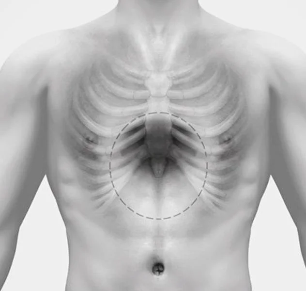 pectus excavatum colombia