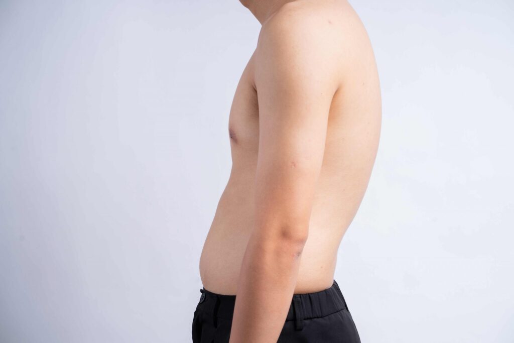 joroba y pectus excavatum