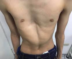 Pectus excavatum asimetrico