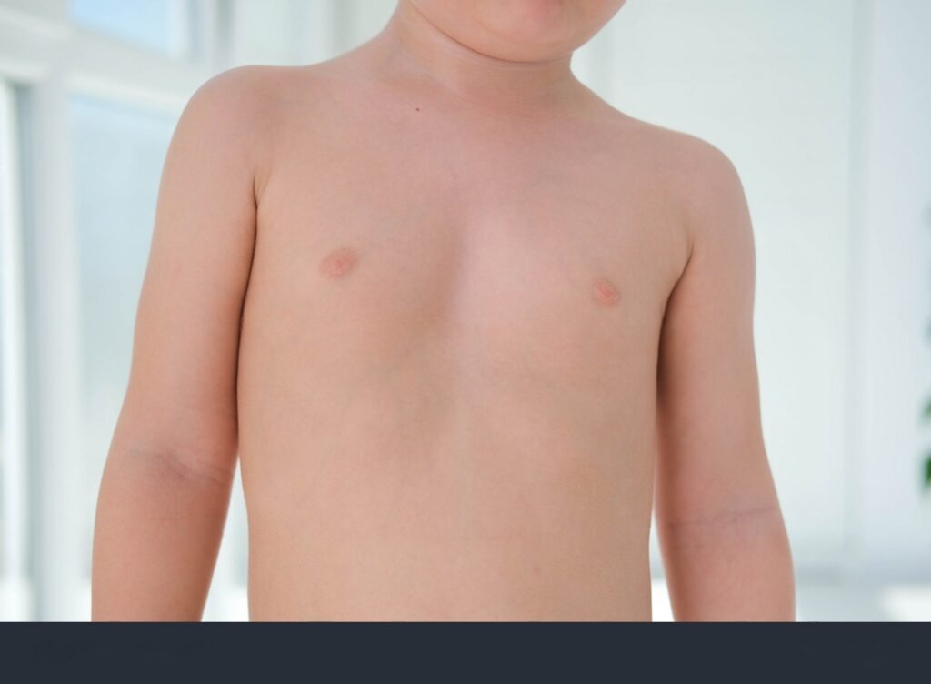 Niño con Pectus excavatum sufriendo impacto psicológico. Ilustración de baja autoestima y el bullying en niños.