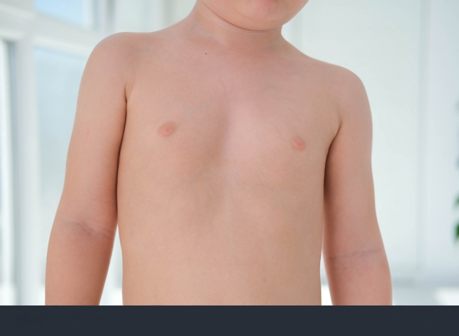 Niño con Pectus excavatum sufriendo impacto psicológico. Ilustración de baja autoestima y el bullying en niños.