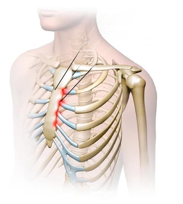 Ilustración del esternón flexible en adolescentes y rígido en adultos, destacando la eficacia del Vacuum Bell para Pectus excavatum antes de los 18 años.